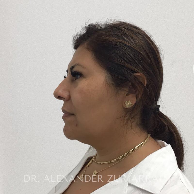 Submental liposuction before & after photo