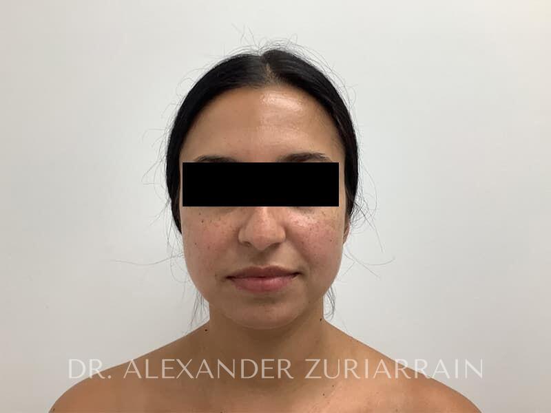 Submental liposuction before & after photo