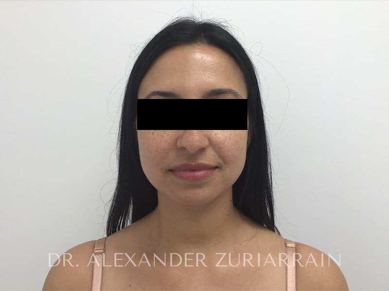 Submental liposuction before & after photo