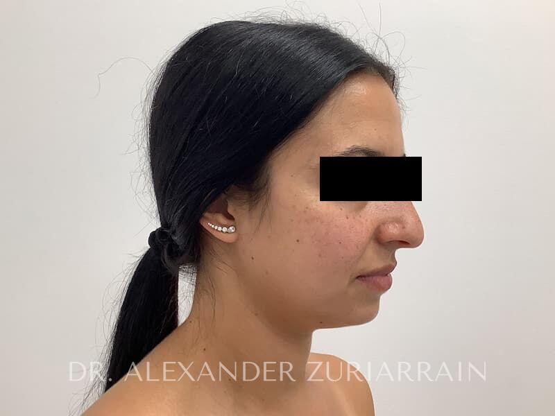Submental liposuction before & after photo