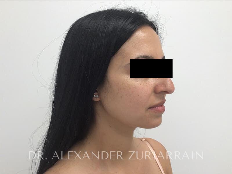 Submental liposuction before & after photo