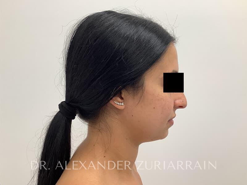 Submental liposuction before & after photo