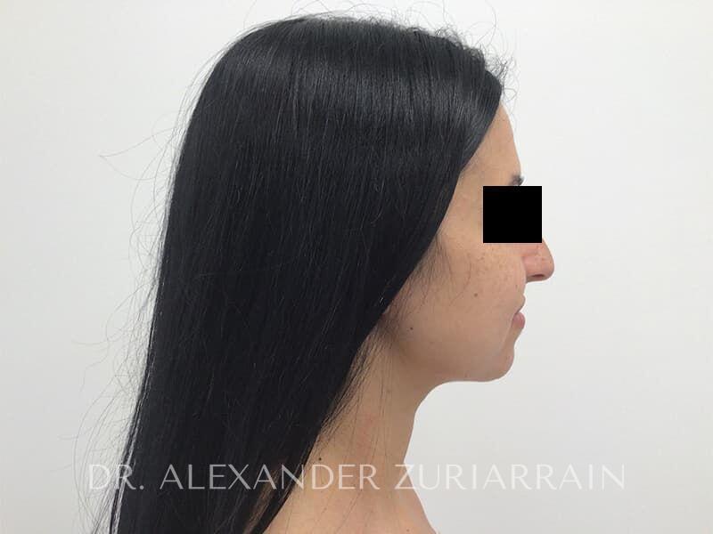 Submental liposuction before & after photo