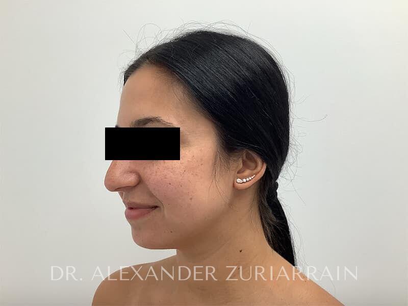 Submental liposuction before & after photo