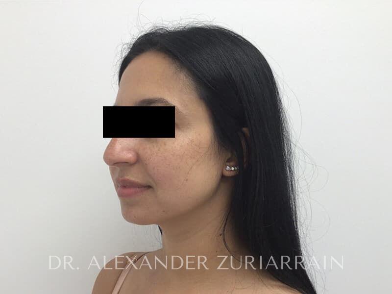 Submental liposuction before & after photo