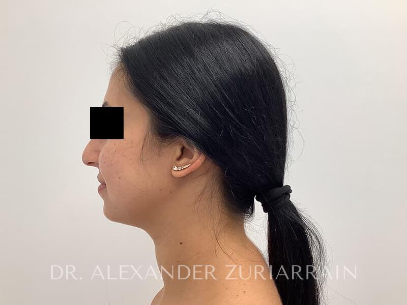 Submental liposuction before & after photo