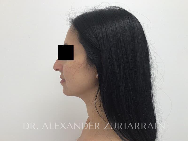Submental liposuction before & after photo