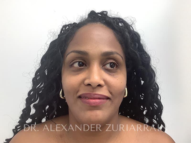 Submental liposuction before & after photo