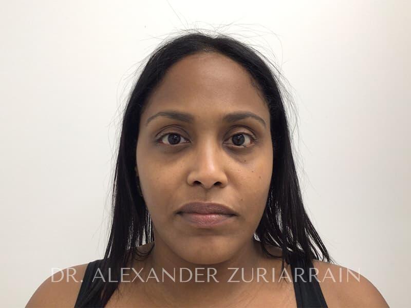 Submental liposuction before & after photo