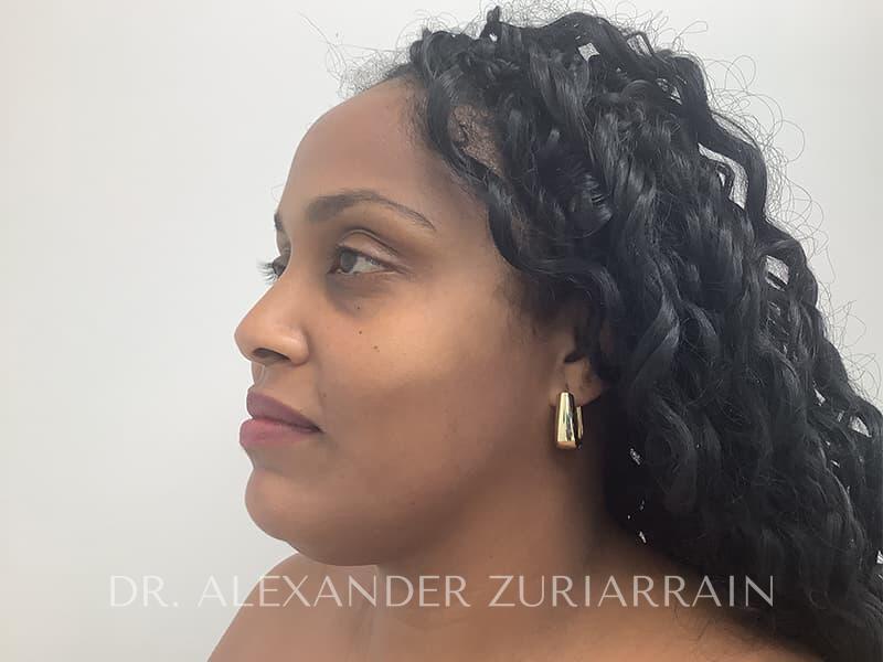 Submental liposuction before & after photo