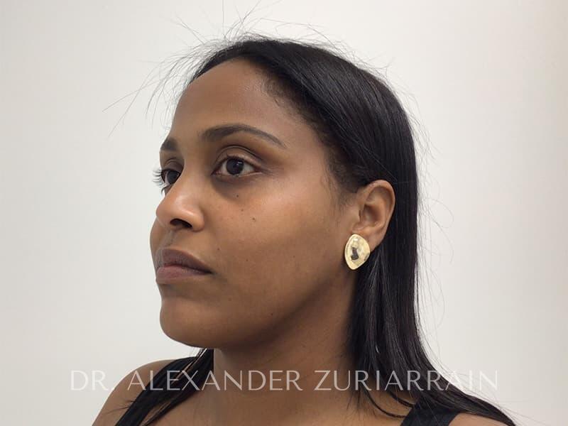 Submental liposuction before & after photo