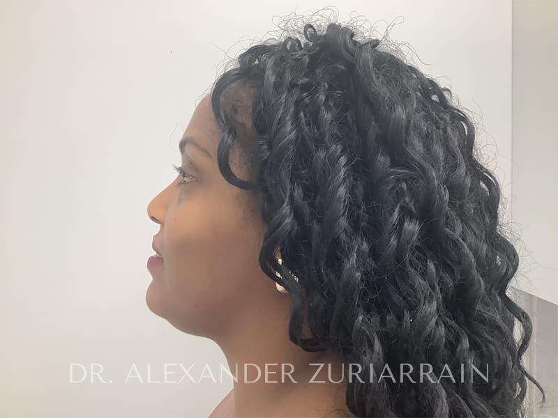 Submental liposuction before & after photo