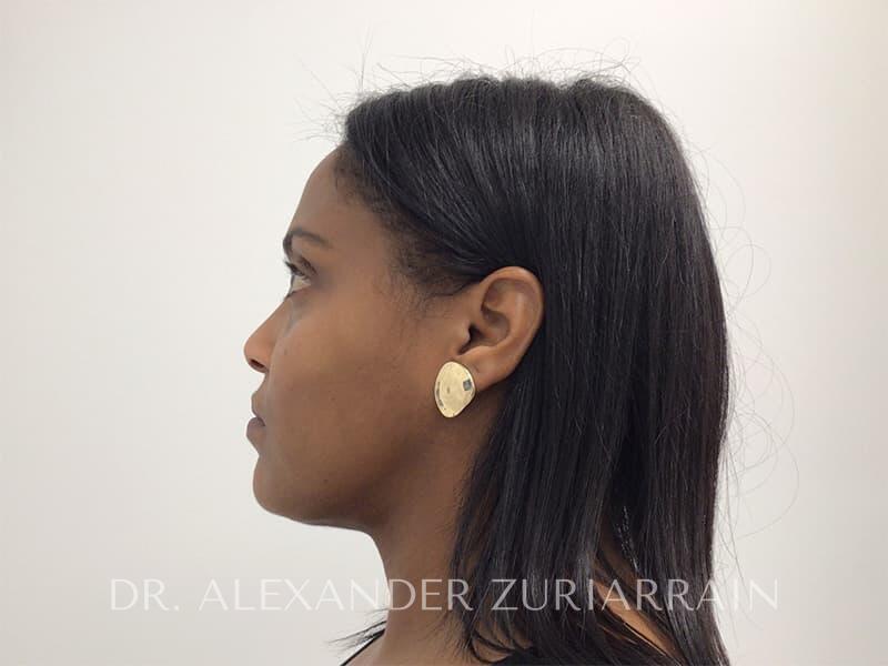 Submental liposuction before & after photo