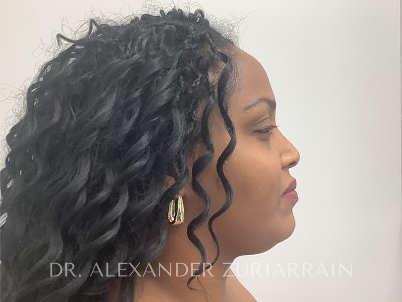 Submental liposuction before & after photo