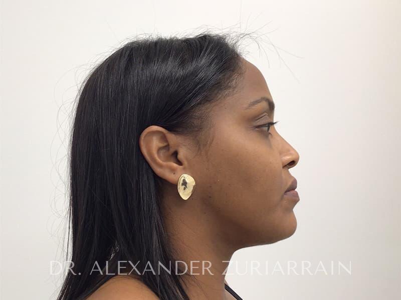 Submental liposuction before & after photo
