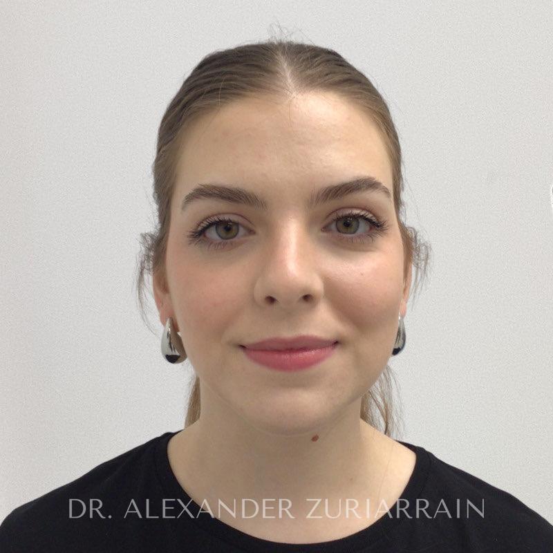 Submental liposuction before & after photo