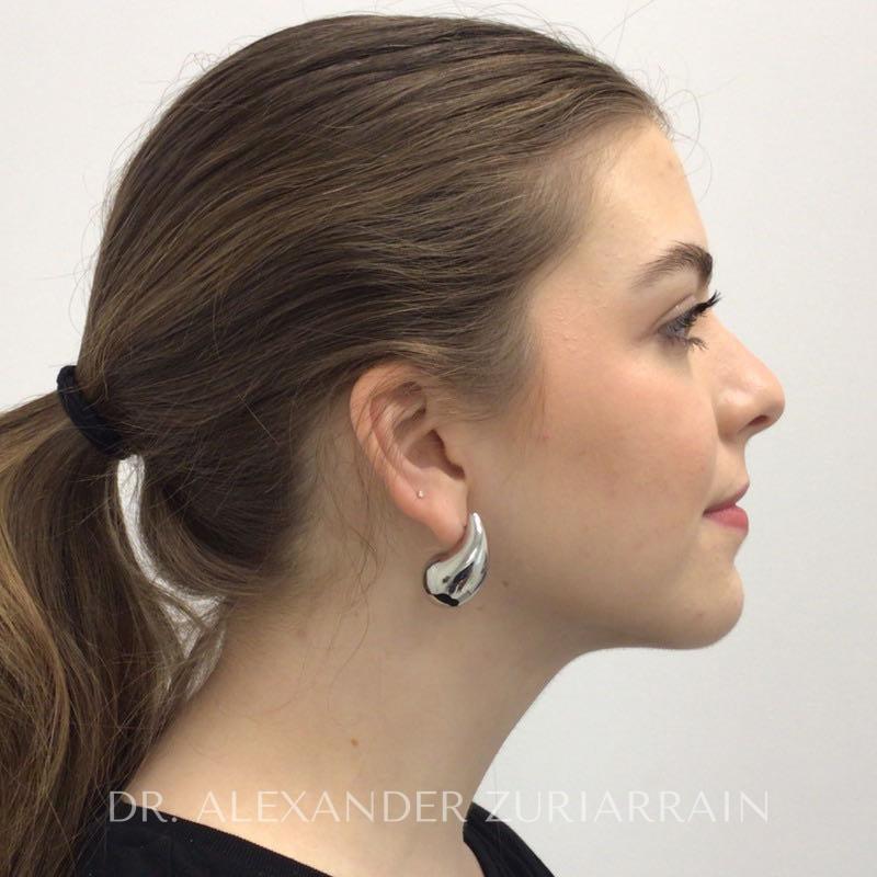 Submental liposuction before & after photo