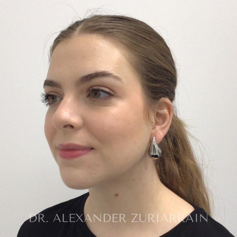 Submental liposuction before & after photo