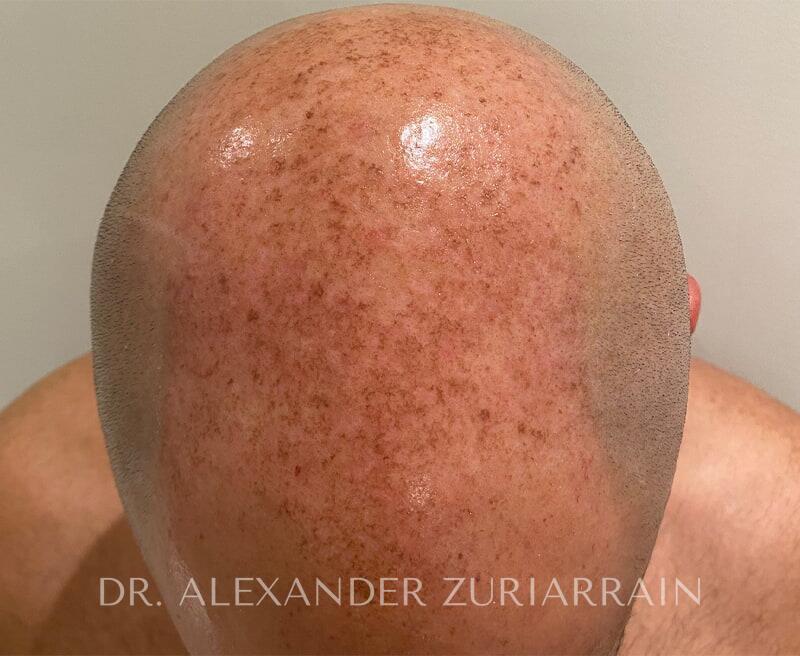 Lumecca Before & After