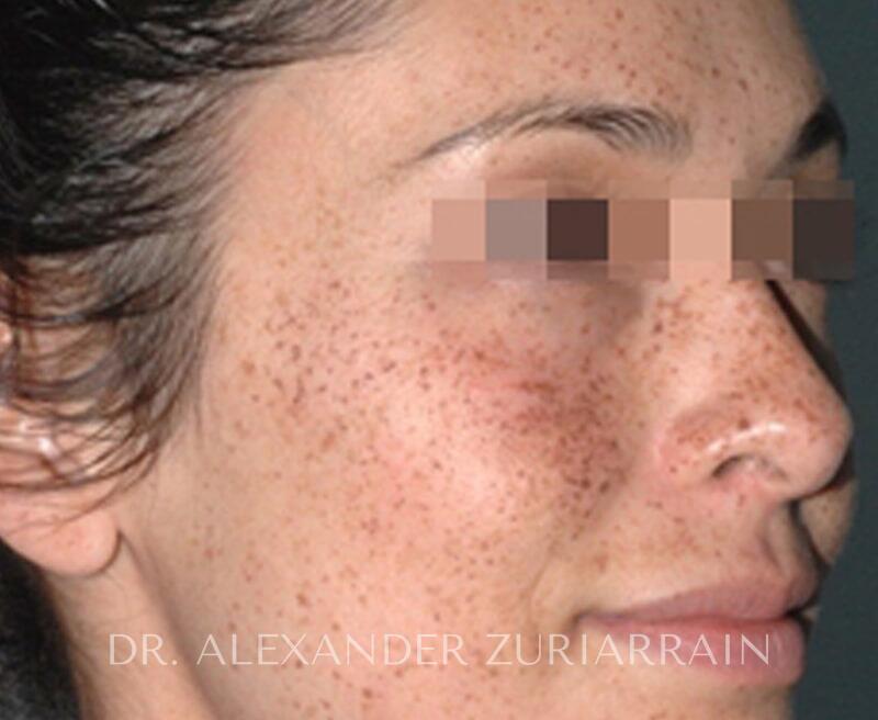 Lumecca Before & After