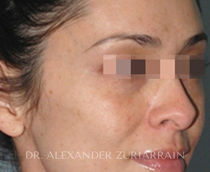 Lumecca Before & After