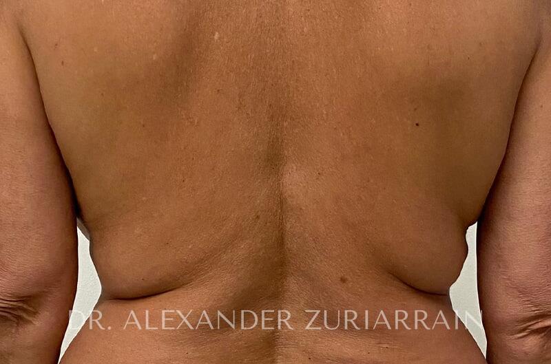 Morpheus8 Before & After