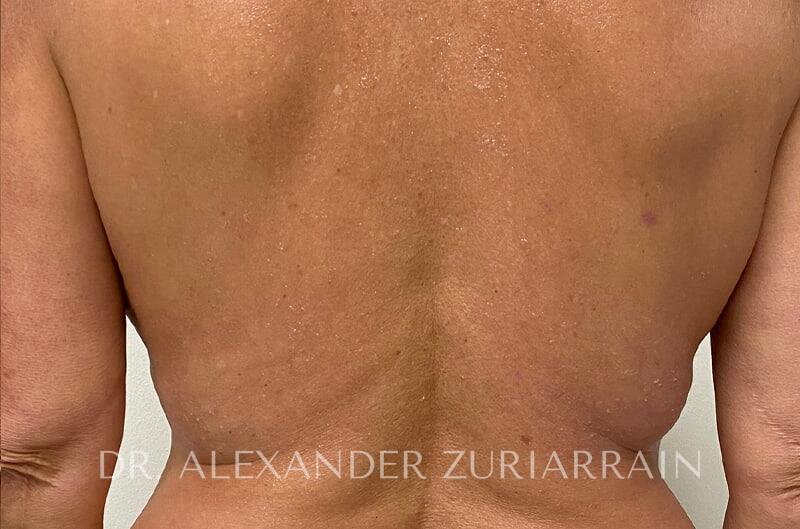 Morpheus8 Before & After