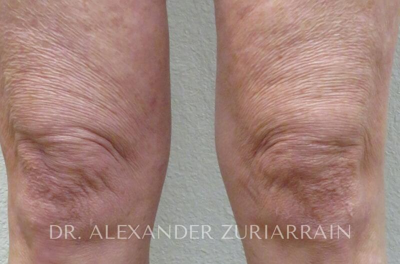 Morpheus8 Before & After