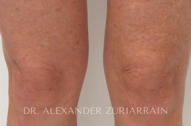 Morpheus8 Before & After