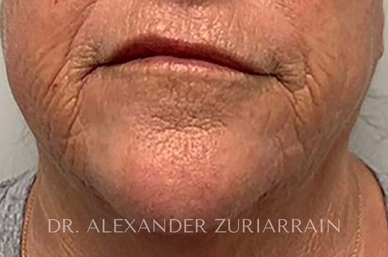 Morpheus8 Before & After