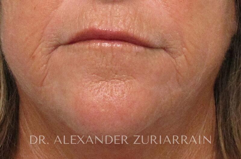 Morpheus8 Before & After