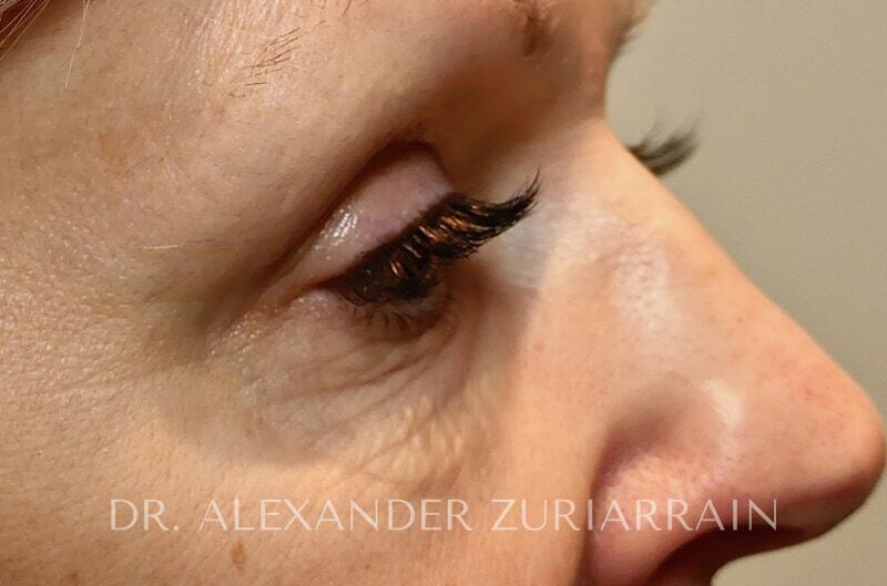 Morpheus8 Before & After