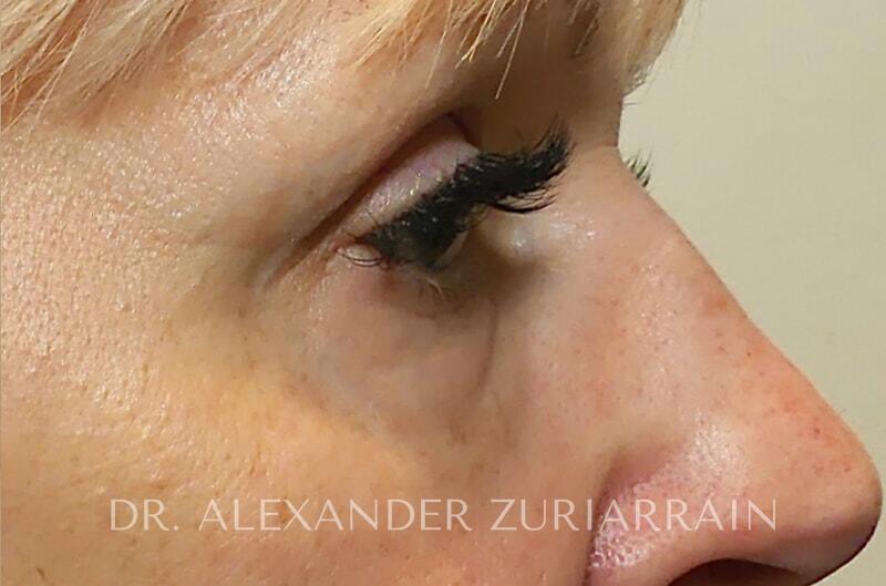 Morpheus8 Before & After