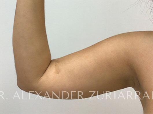 Arm liposuction before & after photo