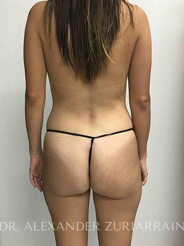 Brazilian butt lift before & after photo