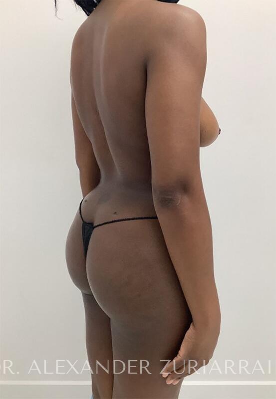 Brazilian butt lift before & after photo