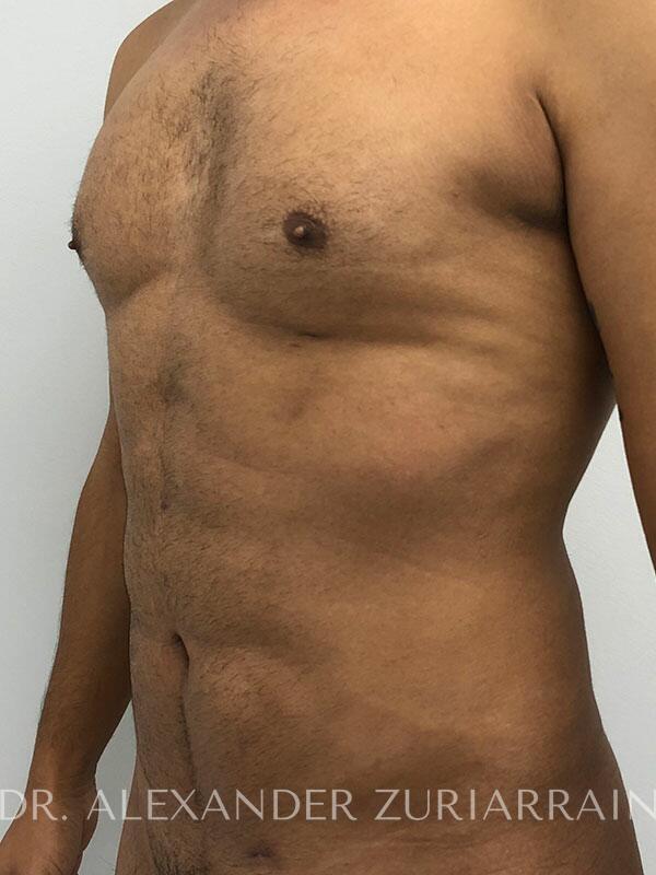 High definition liposuction before & after photo