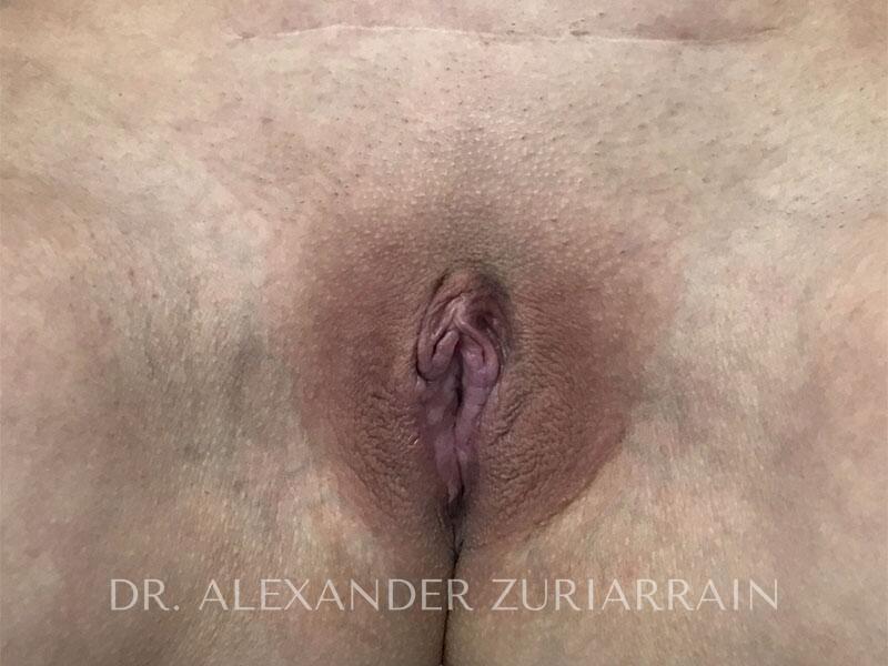 Labiaplasty before & after photo