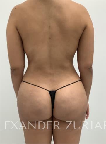 Liposuction before & after photo