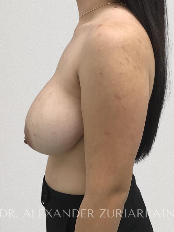 Liposuction before & after photo