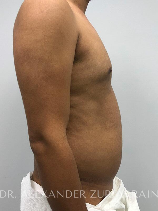 Male liposuction before & after photo
