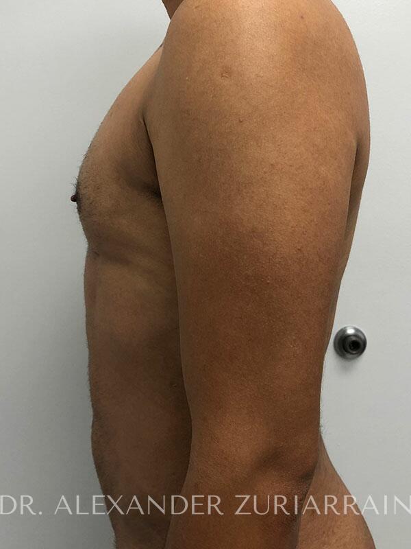 Male liposuction before & after photo