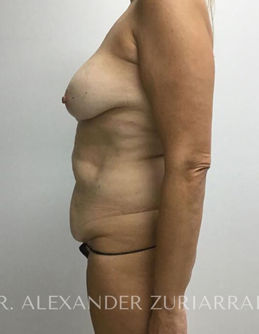 Tummy tuck before & after photo