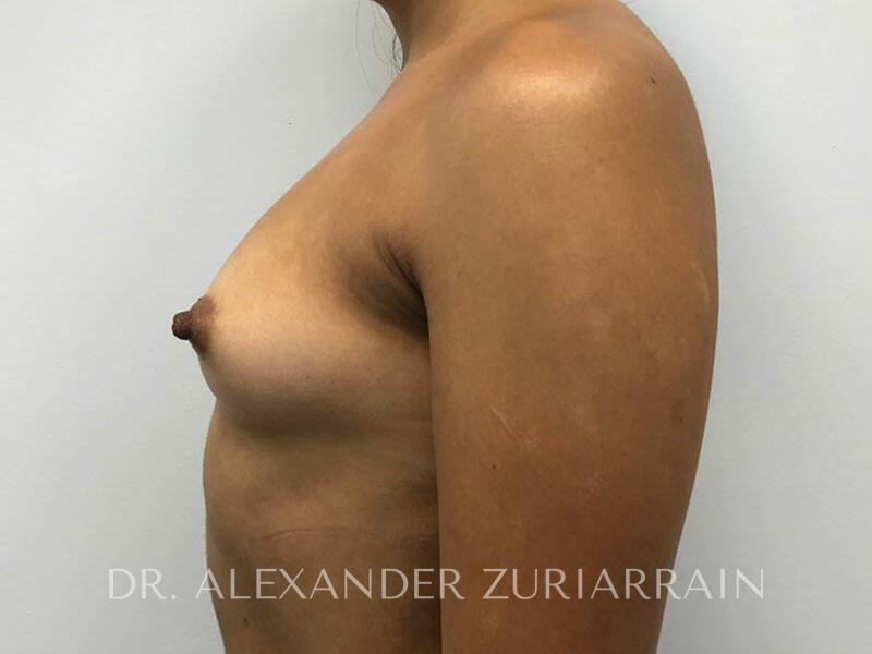 Breast augmentation before & after photo