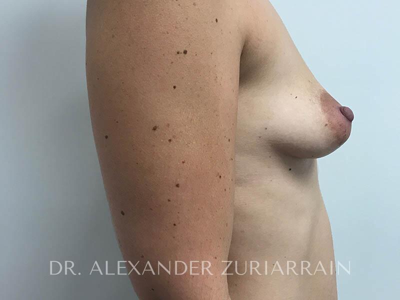 Breast augmentation before & after photo
