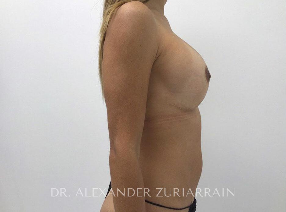 Breast implant removal with lift before & after photo