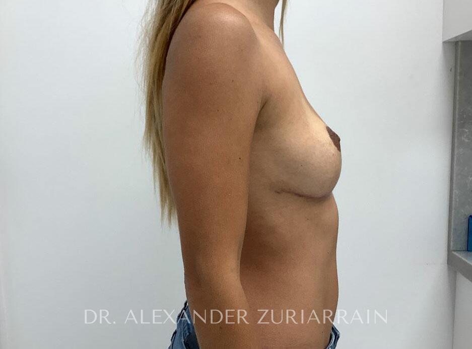 Breast implant removal with lift before & after photo