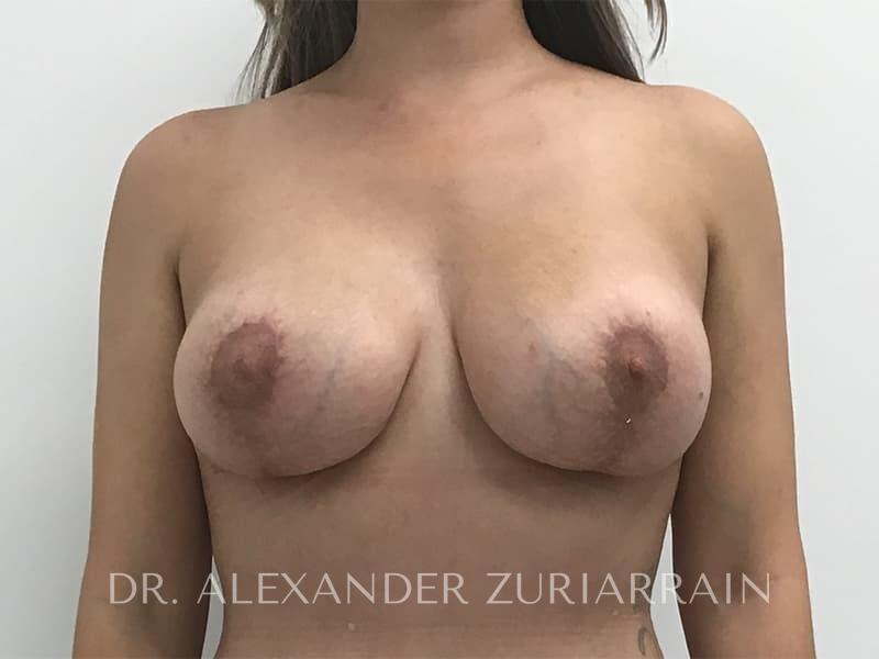 Breast lift before & after photo