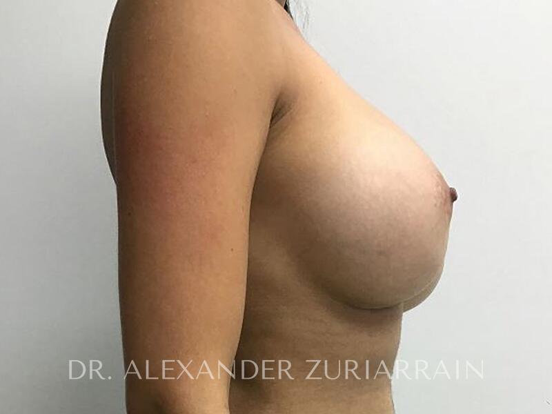 Breast revision before & after photo