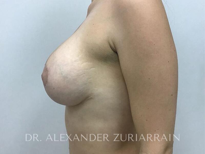 Nipple correction before & after photo